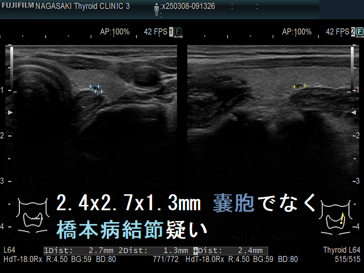 2.4 x 2.7 x 1.3 mm 甲状腺のう胞(甲状腺嚢胞)でなく橋本病結節疑い2 2.4 x 2.7 x 1.3 mm 甲状腺のう胞(甲状腺嚢胞)でなく橋本病結節疑い2