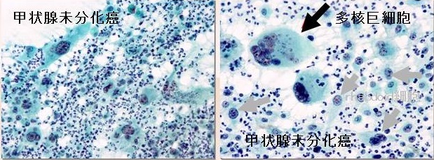 甲状腺未分化癌 細胞診所見 甲状腺未分化癌 細胞診所見