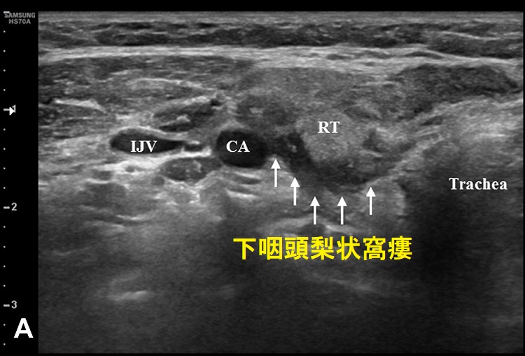 下咽頭梨状窩瘻 超音波(エコー)画像 下咽頭梨状窩瘻 超音波(エコー)画像