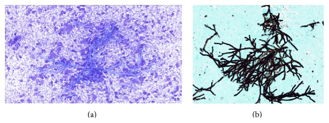 アスペルギルス甲状腺炎の穿刺細胞診所見 アスペルギルス甲状腺炎の穿刺細胞診所見