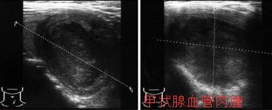 甲状腺血管肉腫 超音波(エコー)画像 甲状腺血管肉腫 超音波(エコー)画像
