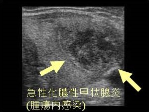 急性化膿性甲状腺炎(腫瘍内感染) 超音波(エコー)画像 急性化膿性甲状腺炎(腫瘍内感染) 超音波(エコー)画像