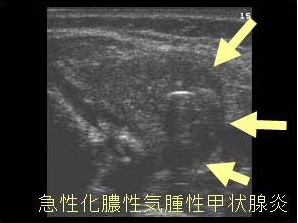 急性化膿性気腫性甲状腺炎 超音波(エコー)画像 急性化膿性気腫性甲状腺炎 超音波(エコー)画像