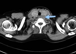 濾胞癌 甲状腺外へ突出 CT画像 濾胞癌 甲状腺外へ突出 CT画像