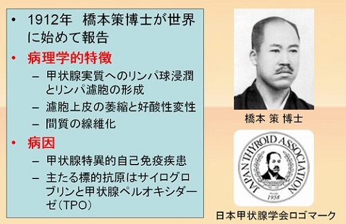 橋本病(慢性甲状腺炎) 橋本病(慢性甲状腺炎)