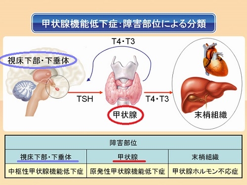 甲状腺機能低下症 障害部位による分類 甲状腺機能低下症 障害部位による分類