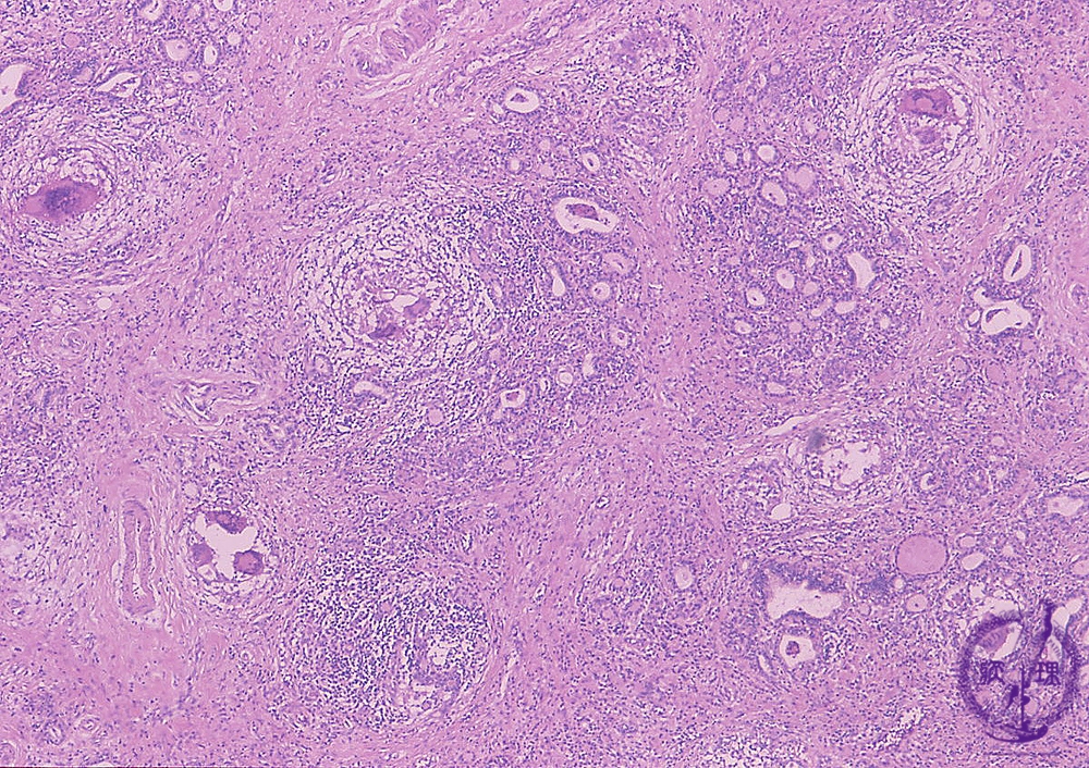 亜急性甲状腺炎 組織像(弱拡大) 亜急性甲状腺炎 組織像(弱拡大)