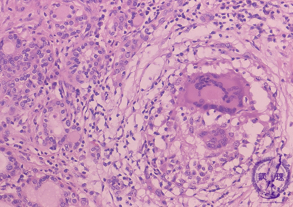 亜急性甲状腺炎 組織像(強拡大) 亜急性甲状腺炎 組織像(強拡大)