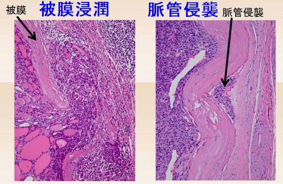 濾胞癌 病理組織(被膜浸潤 脈管侵襲) 濾胞癌 病理組織(被膜浸潤 脈管侵襲)