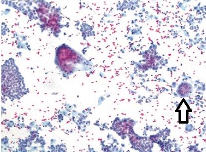 甲状腺乳頭癌 炎症性多核巨細胞 甲状腺乳頭癌 炎症性多核巨細胞