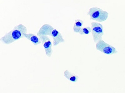 甲状腺乳頭癌高細胞型(TCV)の細胞診 甲状腺乳頭癌高細胞型(TCV)の細胞診