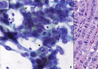 甲状腺乳頭癌高細胞型(TCV)の細胞診(左)と組織像(右) 甲状腺乳頭癌高細胞型(TCV)の細胞診(左)と組織像(右)