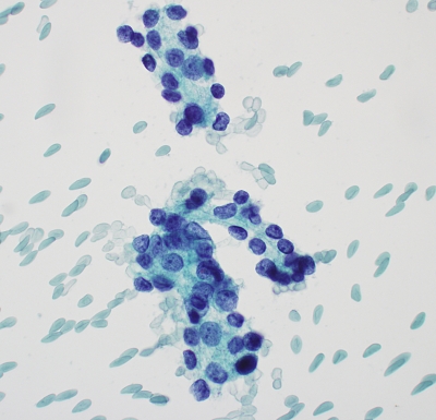 濾胞型甲状腺乳頭癌(follicular variant)細胞診 濾胞型甲状腺乳頭癌(follicular variant)細胞診