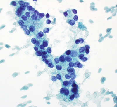 濾胞型甲状腺乳頭癌(follicular variant)細胞診 濾胞型甲状腺乳頭癌(follicular variant)細胞診