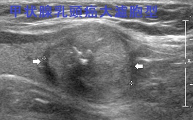 甲状腺乳頭癌大濾胞型 超音波(エコー)画像 甲状腺乳頭癌大濾胞型 超音波(エコー)画像