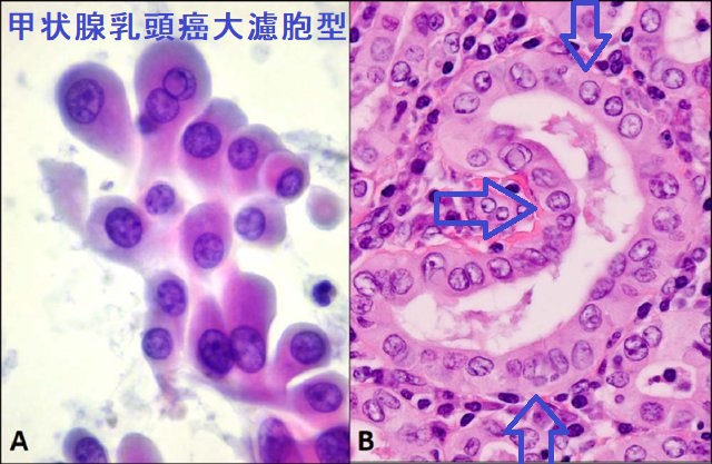 甲状腺乳頭癌大濾胞型の細胞診と組織診 甲状腺乳頭癌大濾胞型の細胞診と組織診