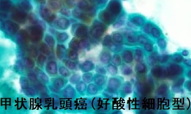 甲状腺乳頭癌(好酸性細胞型) 甲状腺乳頭癌(好酸性細胞型)