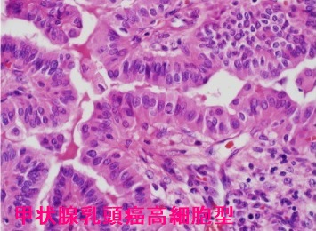 甲状腺乳頭癌高細胞型(TCV) 組織診 甲状腺乳頭癌高細胞型(TCV) 組織診