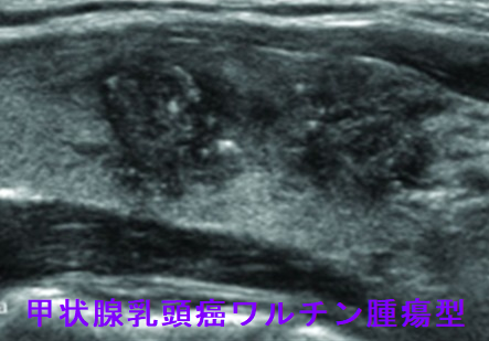 甲状腺乳頭癌ワルチン腫瘍型 超音波(エコー)画像 甲状腺乳頭癌ワルチン腫瘍型 超音波(エコー)画像