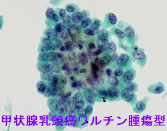 甲状腺乳頭癌ワルチン腫瘍型 細胞診 甲状腺乳頭癌ワルチン腫瘍型 細胞診