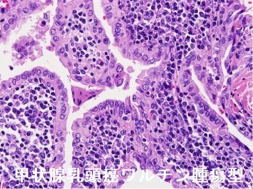 甲状腺乳頭癌ワルチン腫瘍型 組織診 甲状腺乳頭癌ワルチン腫瘍型 組織診