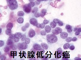 甲状腺低分化癌の細胞診 甲状腺低分化癌の細胞診