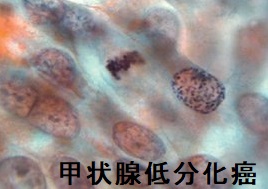 甲状腺低分化癌の細胞診 甲状腺低分化癌の細胞診