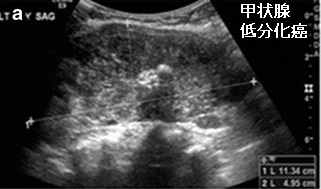 甲状腺低分化癌(乳頭癌由来) 甲状腺低分化癌(乳頭癌由来)