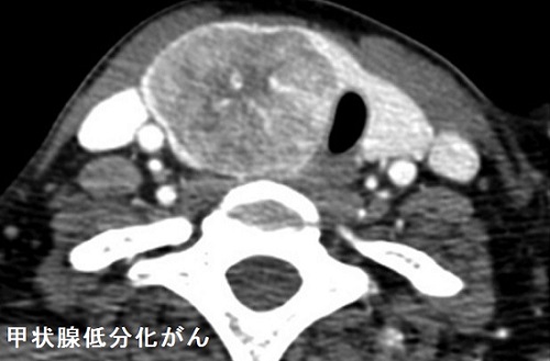 甲状腺低分化癌のCT画像 甲状腺低分化がん CT画像