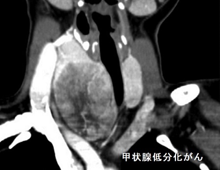 甲状腺低分化がん CT画像 甲状腺低分化がん CT画像