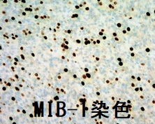 甲状腺低分化癌乳頭癌型 MIB-1(Ki-67)を染色 甲状腺低分化癌乳頭癌型 MIB-1(Ki-67)を染色