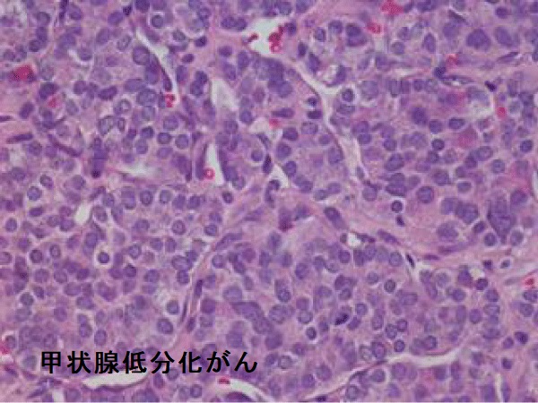 甲状腺低分化癌乳頭癌型 甲状腺低分化癌乳頭癌型