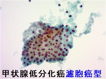 甲状腺低分化癌濾胞癌型 細胞診 甲状腺低分化癌濾胞癌型 細胞診