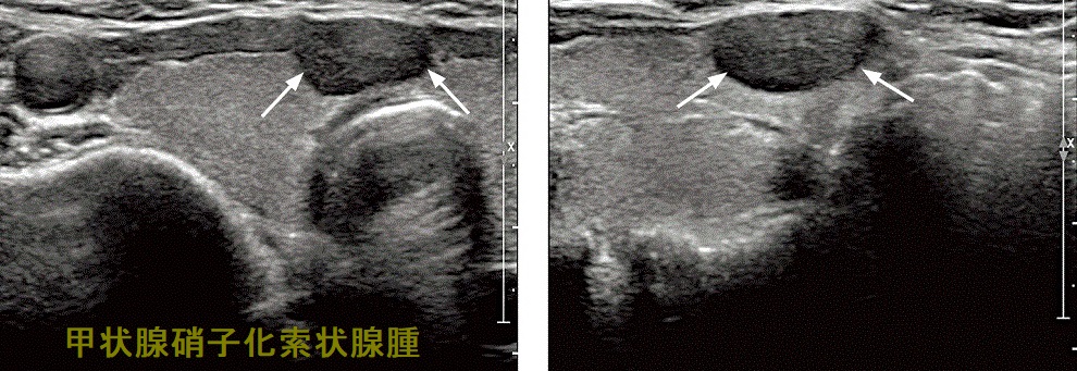 甲状腺硝子化索状腺腫 超音波(エコー)画像 甲状腺硝子化索状腺腫 超音波(エコー)画像