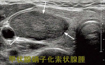 甲状腺硝子化索状腺腫 超音波(エコー)画像 甲状腺硝子化索状腺腫 超音波(エコー)画像