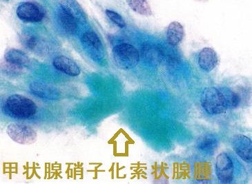 甲状腺硝子化索状腺腫 細胞診 甲状腺硝子化索状腺腫 細胞診