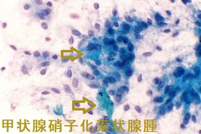 甲状腺硝子化索状腺腫 細胞診 甲状腺硝子化索状腺腫 細胞診