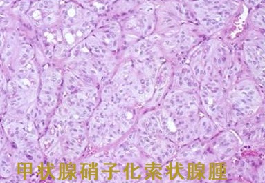 甲状腺硝子化索状腺腫 組織診 甲状腺硝子化索状腺腫 組織診
