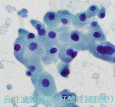 良性濾胞腺腫(好酸性細胞型) 良性濾胞腺腫(好酸性細胞型)