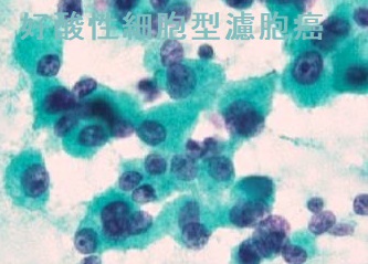 甲状腺濾胞癌(好酸性細胞型)細胞診 甲状腺濾胞癌(好酸性細胞型)細胞診