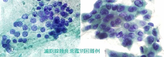 濾胞腺腫良悪鑑別困難例 細胞診 濾胞腺腫良悪鑑別困難例 細胞診
