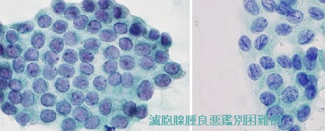 濾胞腺腫良悪鑑別困難例 細胞診 濾胞腺腫良悪鑑別困難例 細胞診