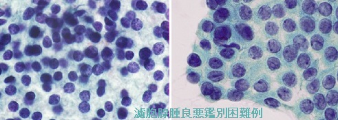 濾胞腺腫良悪鑑別困難例 細胞診 濾胞腺腫良悪鑑別困難例 細胞診