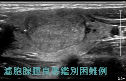 濾胞腺腫良悪鑑別困難例 濾胞腺腫良悪鑑別困難例