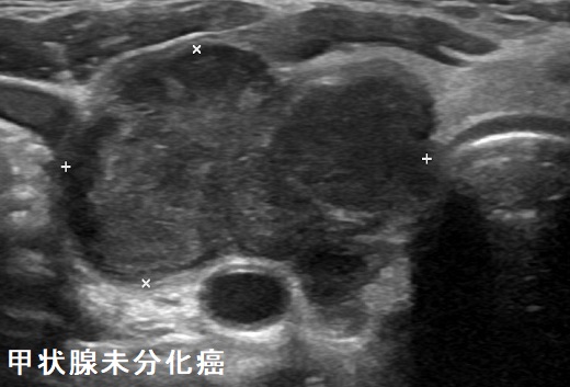 甲状腺未分化癌 超音波(エコー)画像 甲状腺未分化癌 超音波(エコー)画像