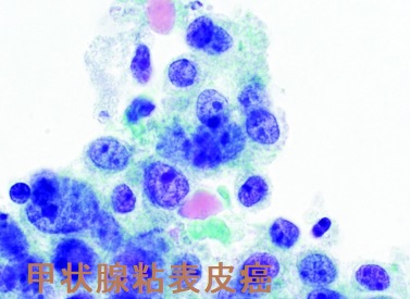 甲状腺粘表皮癌 細胞診 甲状腺粘表皮癌 細胞診