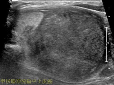 甲状腺原発扁平上皮癌 超音波(エコー)画像 甲状腺原発扁平上皮癌 超音波(エコー)画像