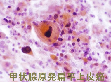 甲状腺原発扁平上皮癌 細胞診 甲状腺原発扁平上皮癌 細胞診