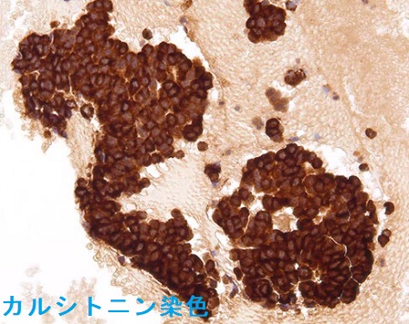 甲状腺髄様癌 細胞診 カルシトニン染色 甲状腺髄様癌 細胞診 カルシトニン染色