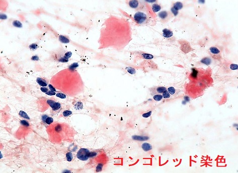 甲状腺髄様癌 細胞診 コンゴレッド染色 甲状腺髄様癌 細胞診 コンゴレッド染色